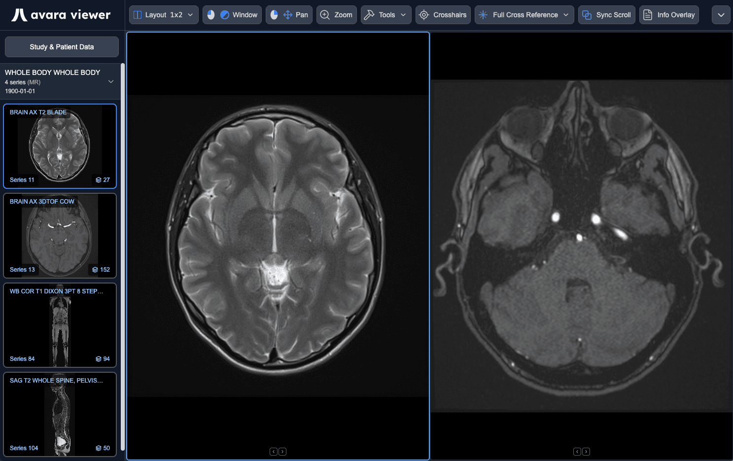 MRI Brain study open in Avara Viewer